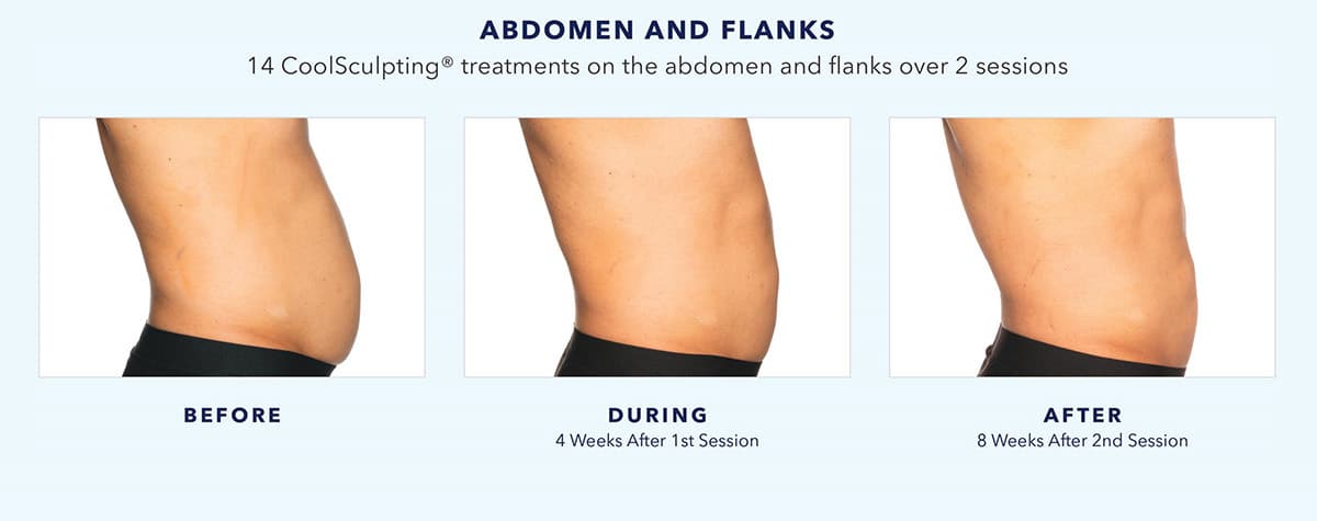 CoolSculpting Elite for Upper Arm Fat in Dallas-Ft. Worth, TX