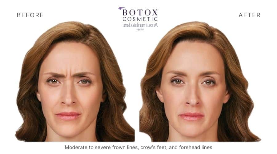 Botox before and after, eliminating moderate to severe frown lines, crow's feet. and forehead lines of a woman.