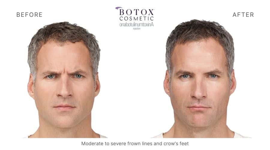 Botox before and after, eliminating moderate to severe frown lines and the crow's feet of a man.