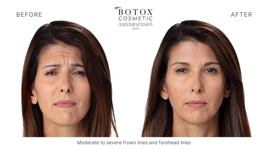 Botox before and after, eliminating moderate to severe frown lines and forehead lines in a woman.