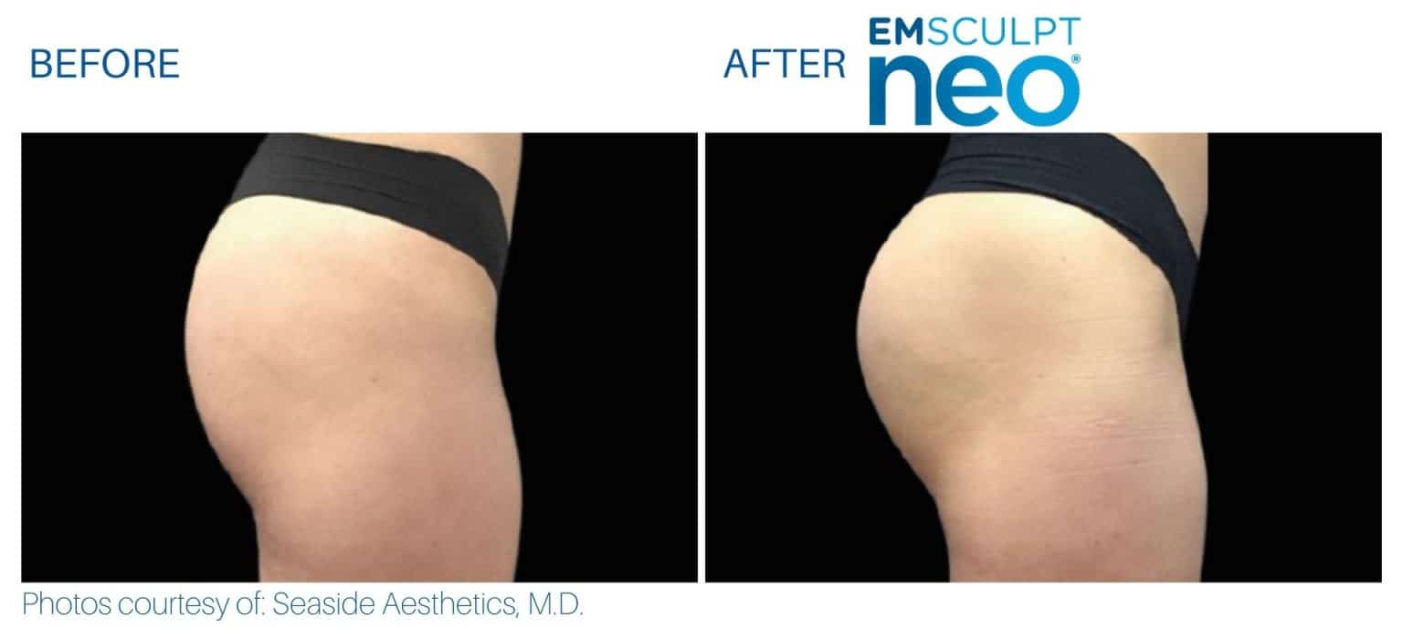 Emsculpt Neo Dallas Build And Sculpt Muscles Burn Fat Fda Cleared