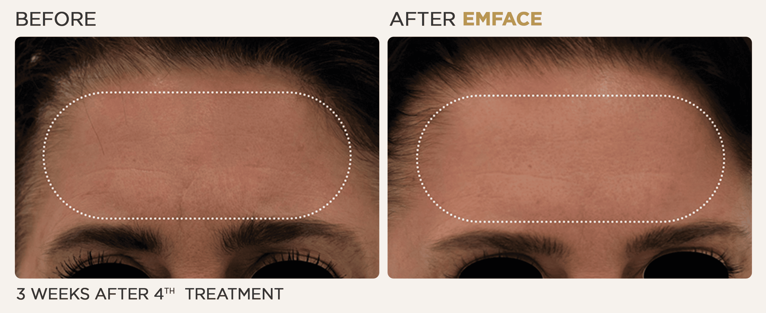 Woman's forehead showing before and after results from EMface treatment at Vitalyc Medspa in Addison.