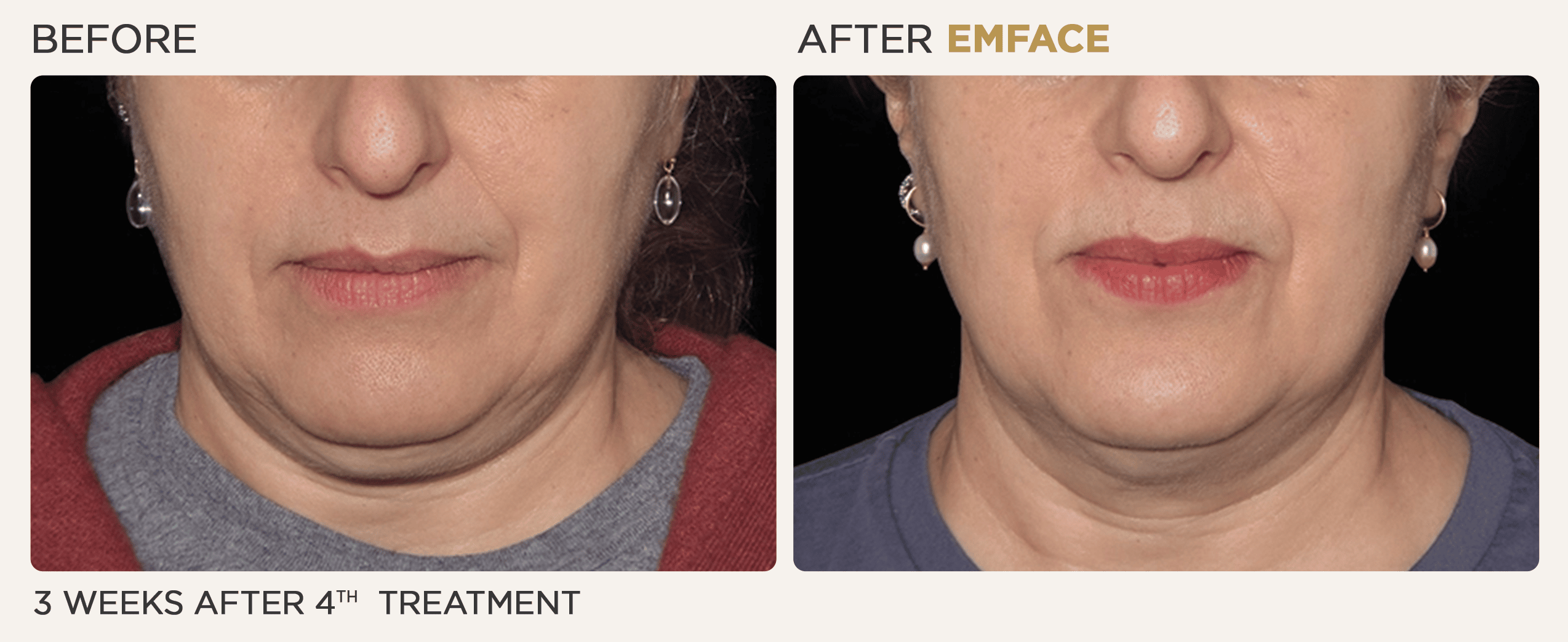 Woman's lower face showing before and after results from EMface treatment at Vitalyc Medspa in Addison.