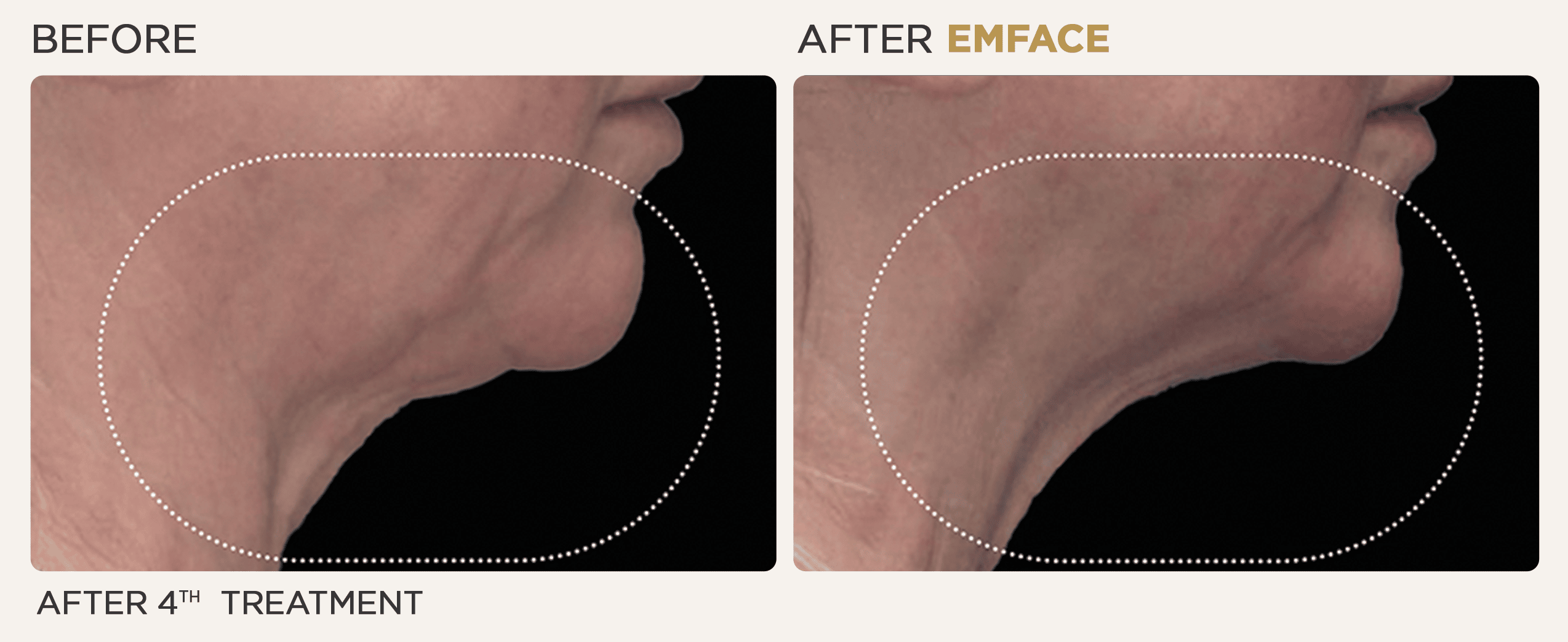 Woman's neck showing before and after results from EMface treatment at Vitalyc Medspa in Addison.