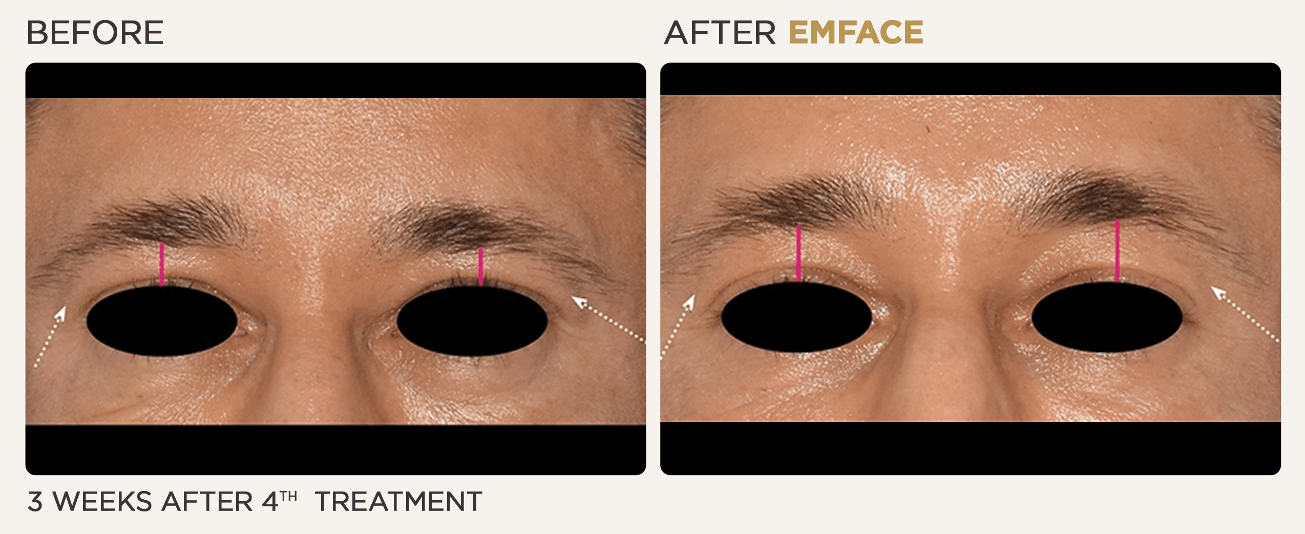 Man's eyebrow showing before and after results from EMface treatment at Vitalyc Medspa in Addison.