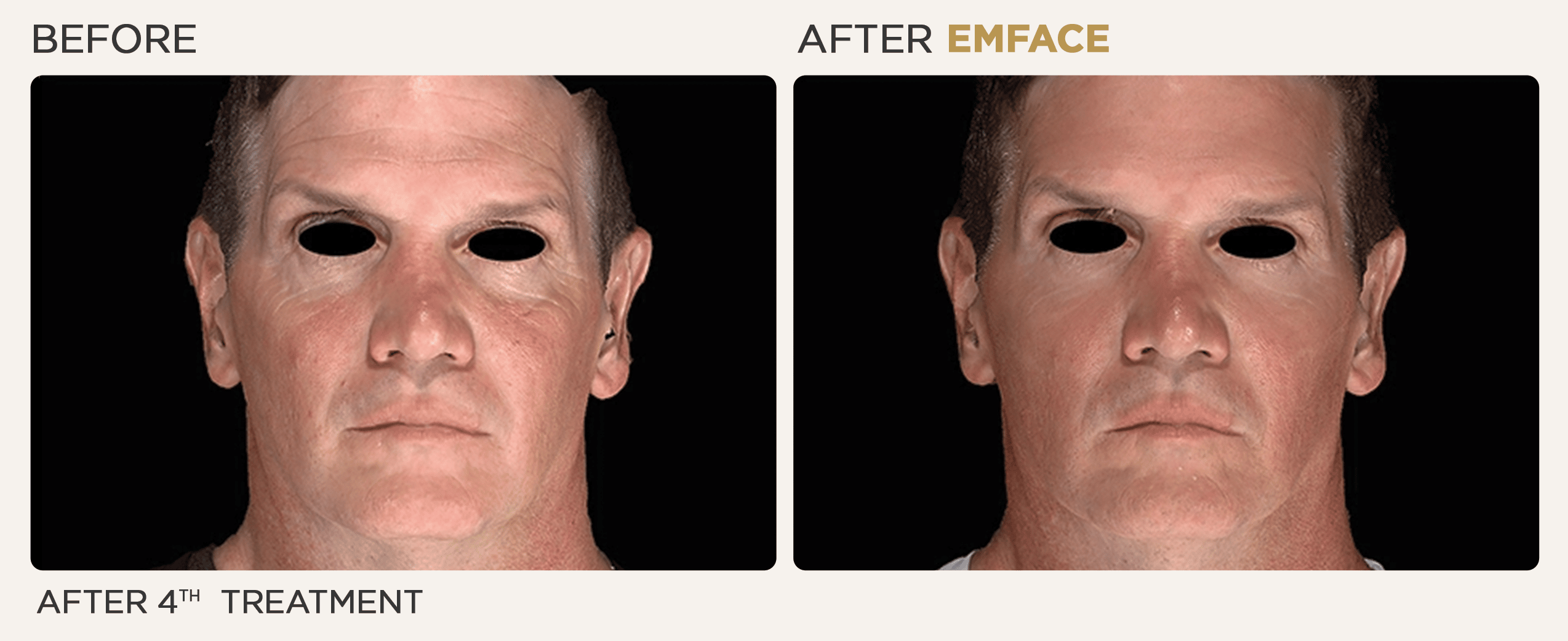 Man's face showing before and after results from EMface treatment at Vitalyc Medspa in Addison.