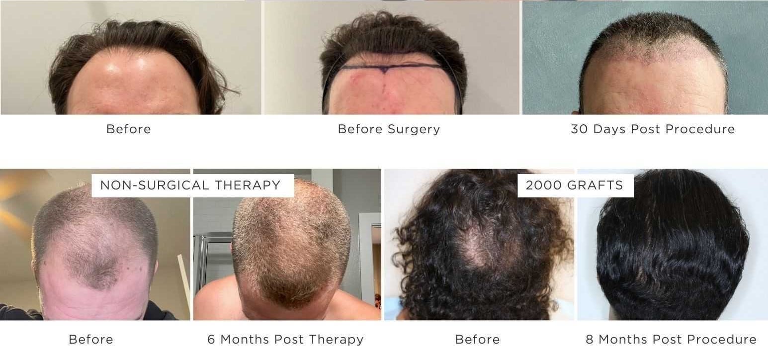 hair-transplant-before & after-img