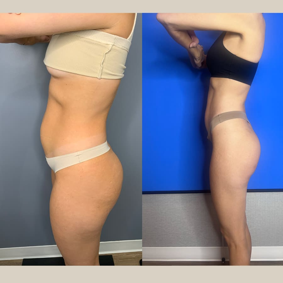 weight loss injections Before and After-1