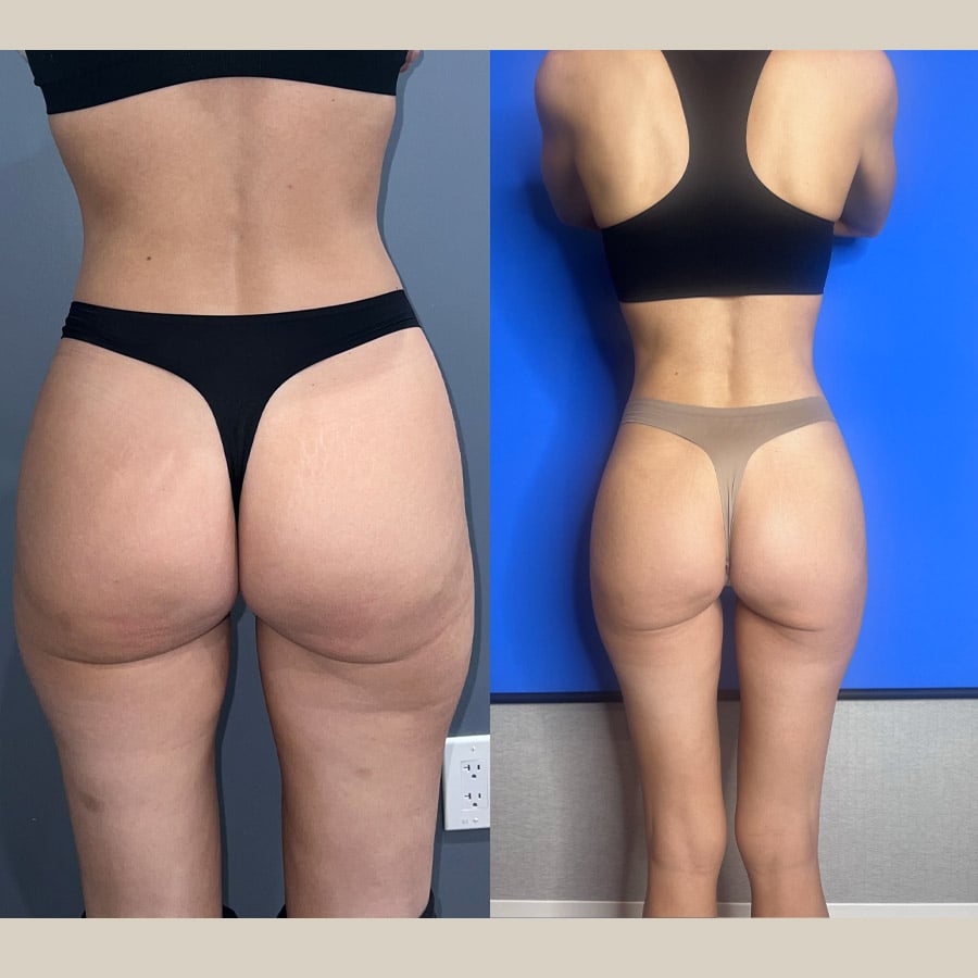 weight loss injections-Before-and-After-2